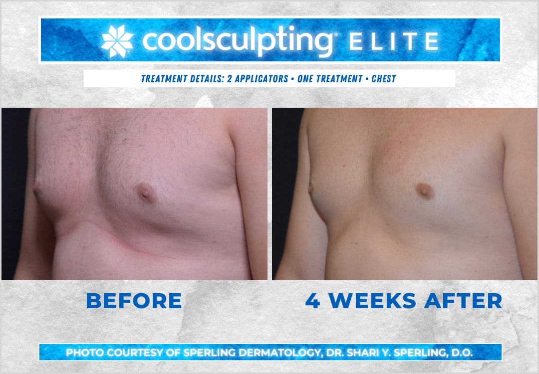 Before & After Pecs CoolSculpting in New Jersey