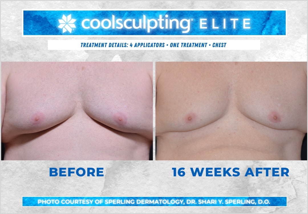 Before & After Pecs CoolSculpting in New Jersey