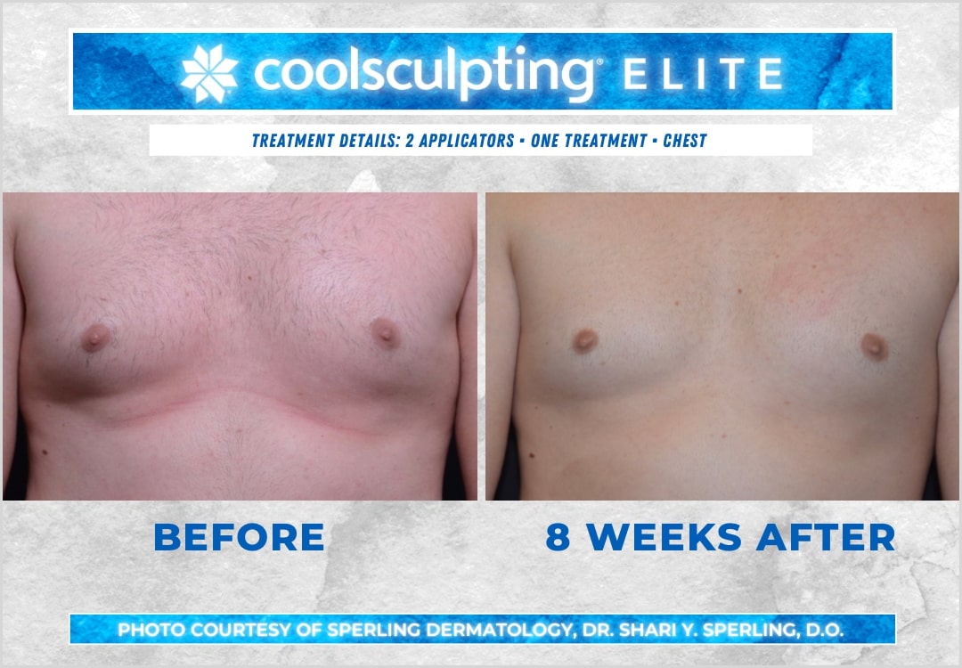 Before & After Pecs CoolSculpting in New Jersey