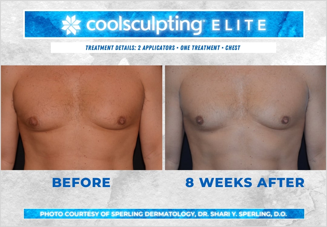 Before & After Pecs CoolSculpting in New Jersey