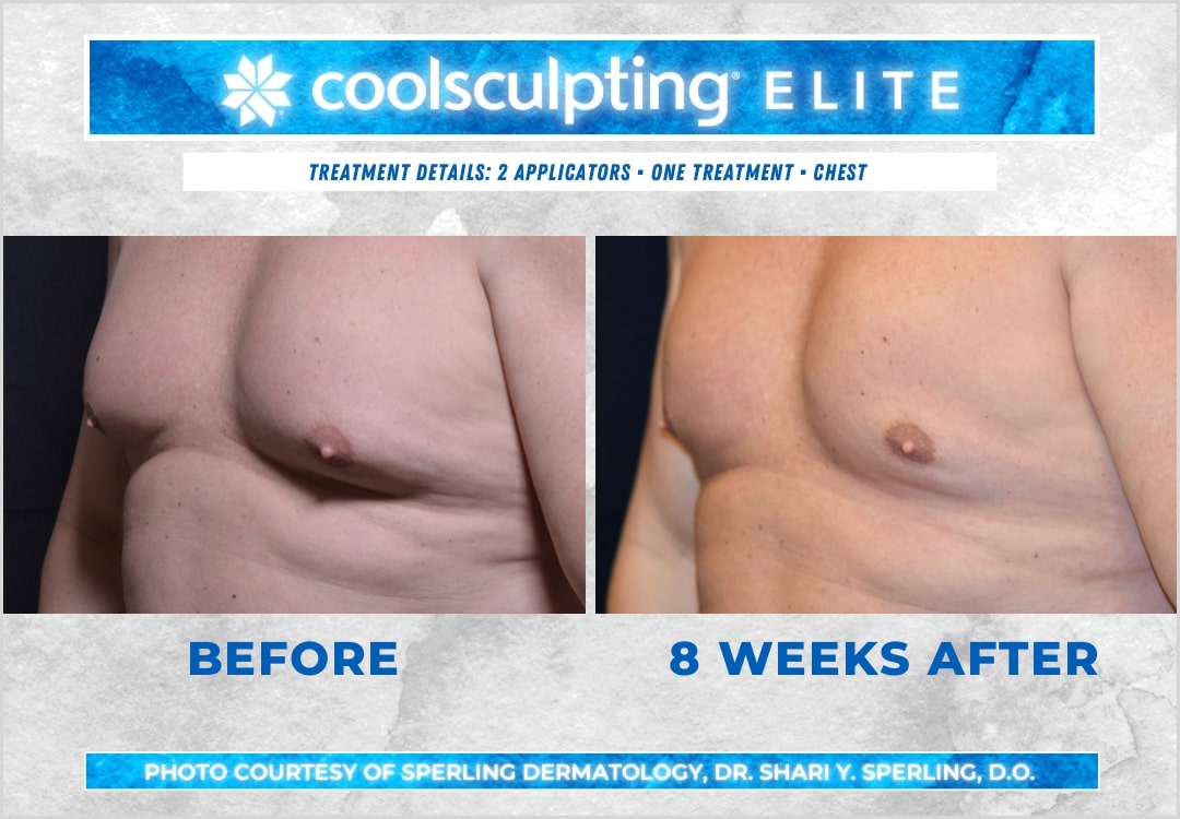 Before & After Pecs CoolSculpting in New Jersey