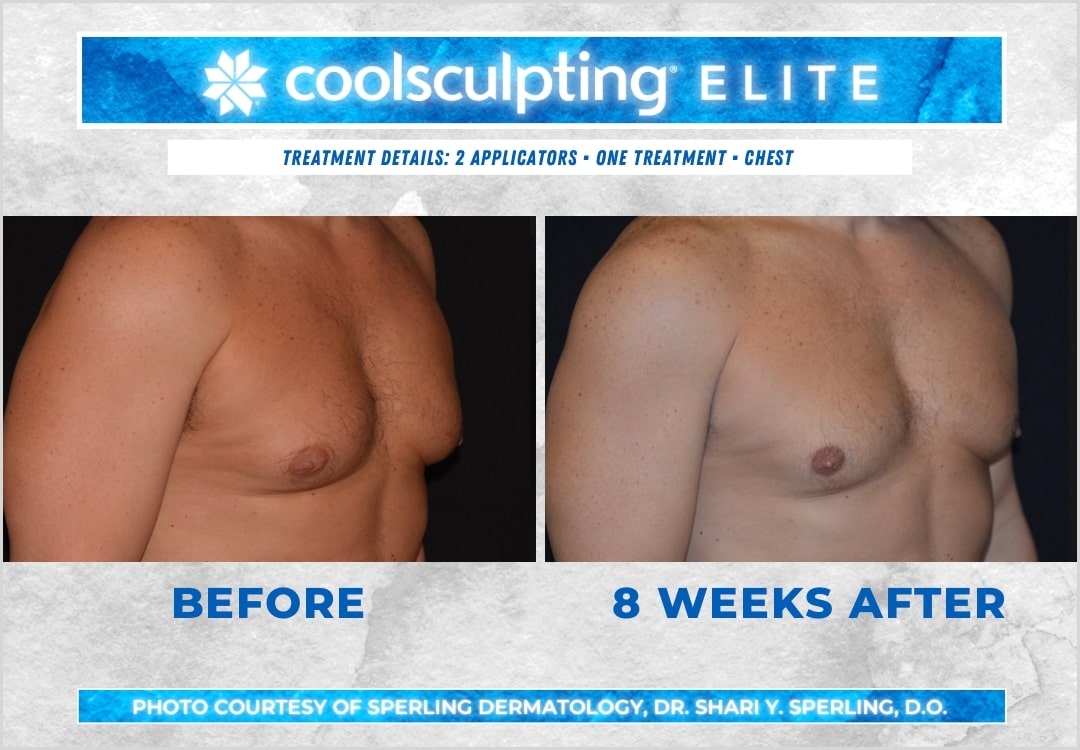 Before & After Pecs CoolSculpting in New Jersey