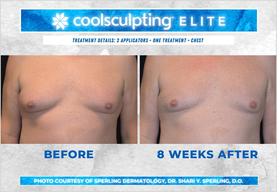 Before & After Pecs CoolSculpting in New Jersey