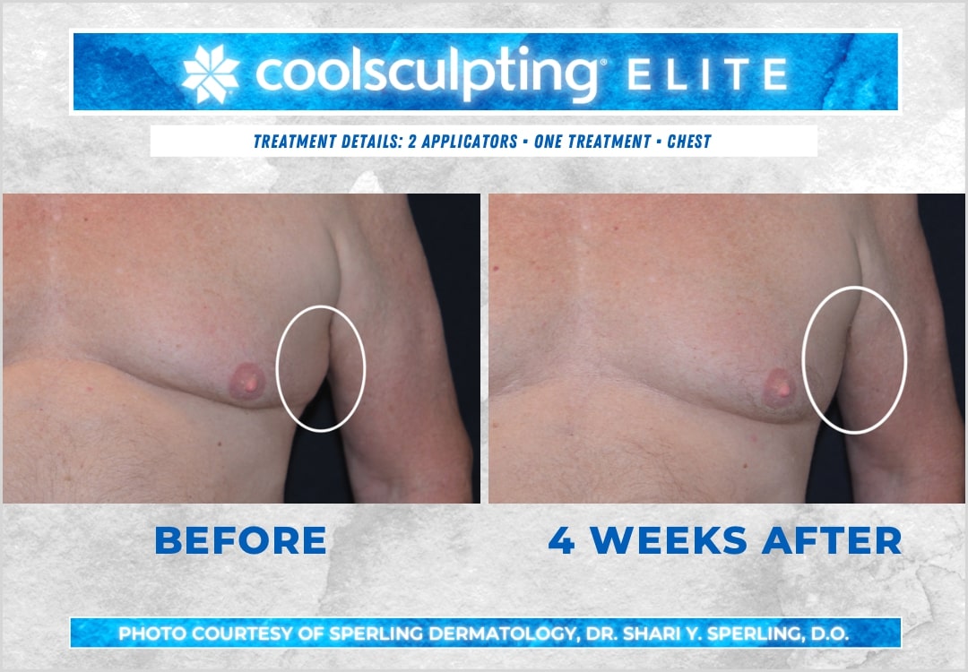 Before & After Pecs CoolSculpting in New Jersey