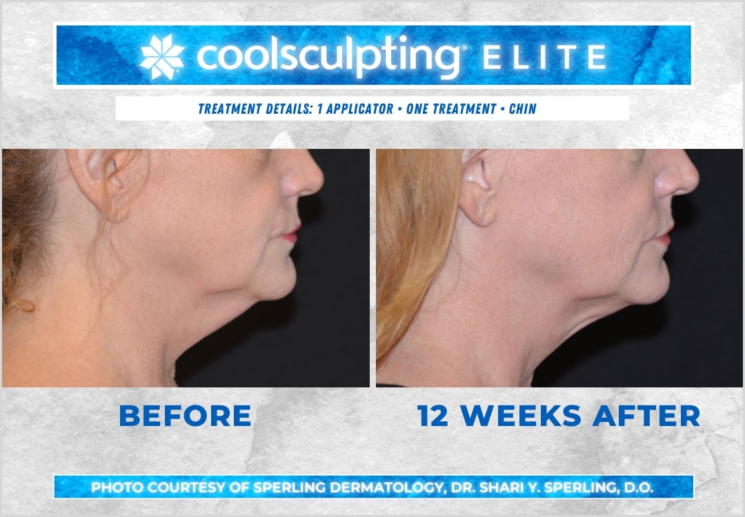 Before & After Submental Fat CoolSculpting in New Jersey