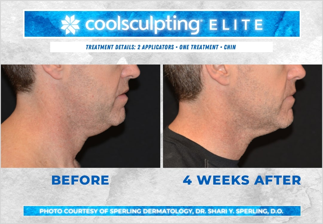 Before & After Submental Fat CoolSculpting in New Jersey