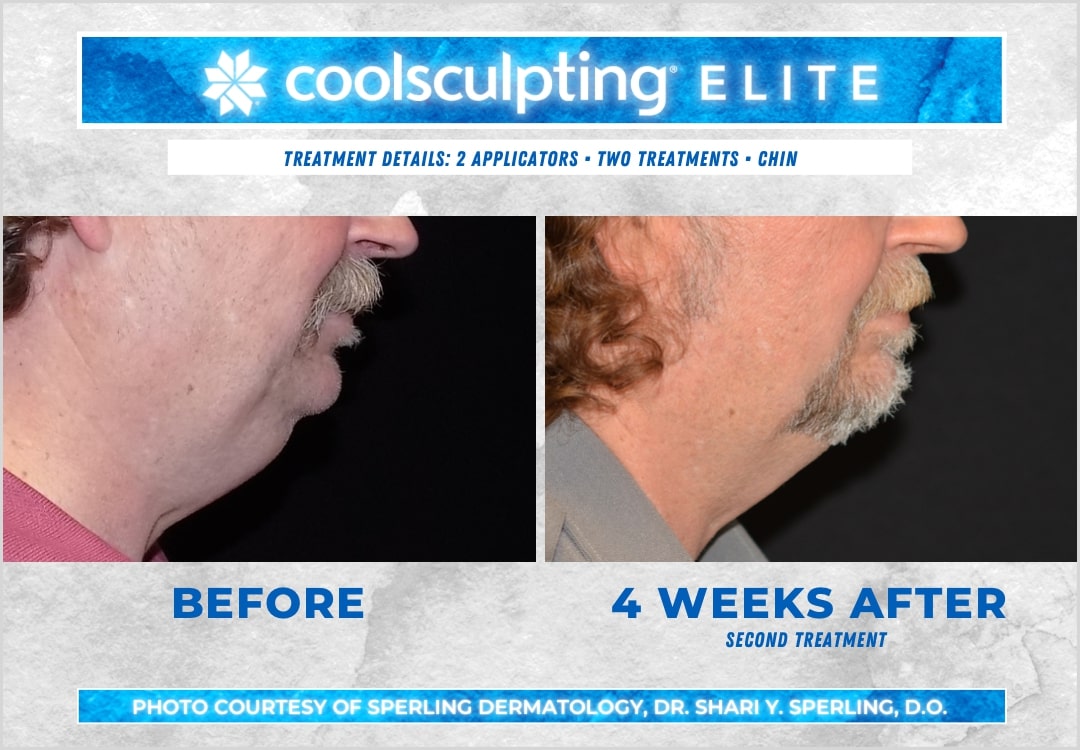 Before & After Submental Fat CoolSculpting in New Jersey