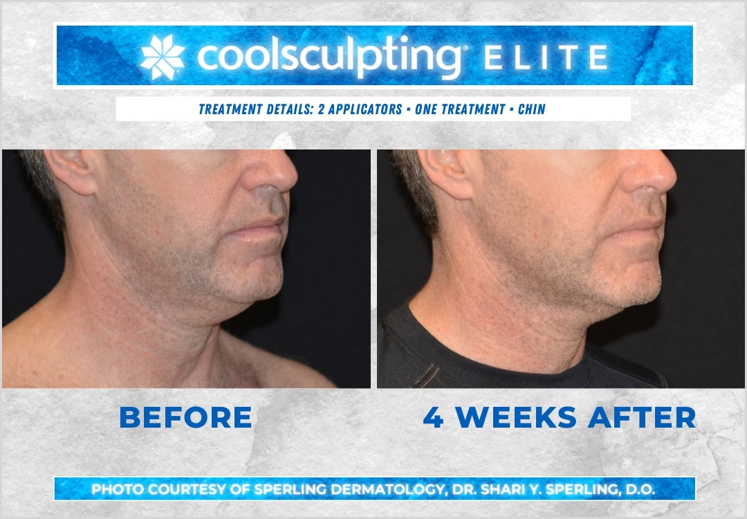 Before & After Submental Fat CoolSculpting in New Jersey