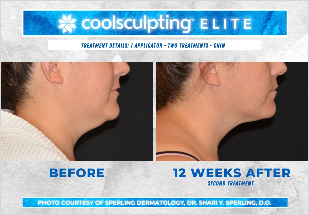 Before & After Submental Fat CoolSculpting in New Jersey