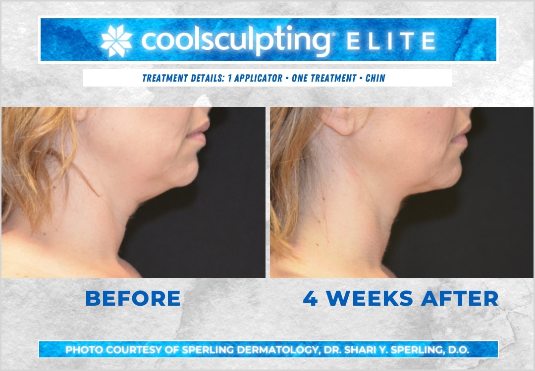 Before & After Submental Fat CoolSculpting in New Jersey