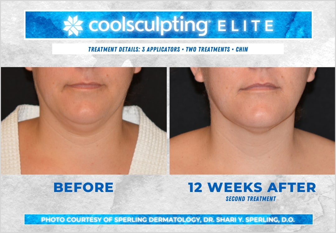 Before & After Submental Fat CoolSculpting in New Jersey