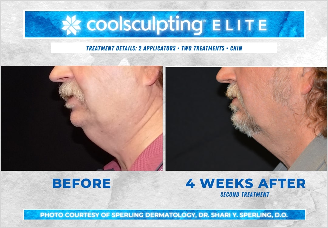 Before & After Submental Fat CoolSculpting in New Jersey