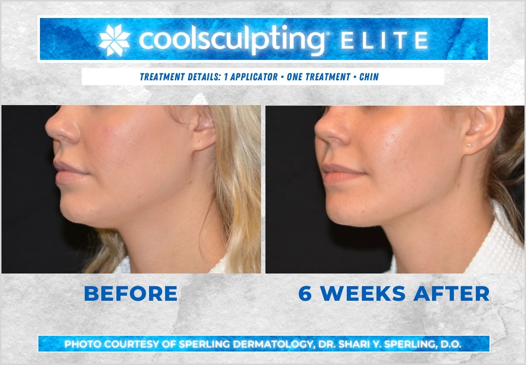 Before & After Submental Fat CoolSculpting in New Jersey