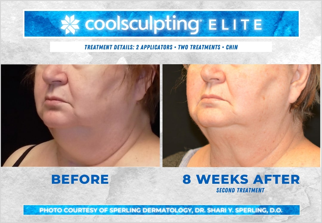 Before & After Submental Fat CoolSculpting in New Jersey