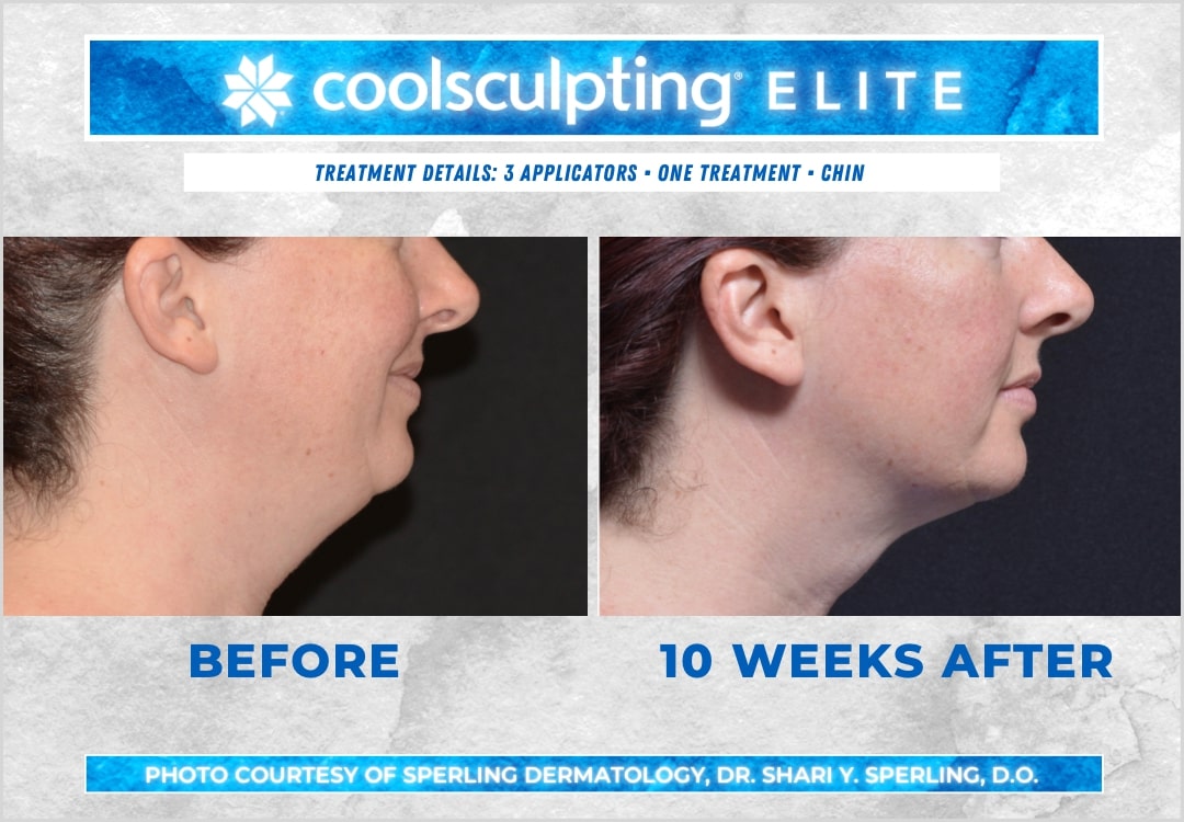 Before & After Submental Fat CoolSculpting in New Jersey