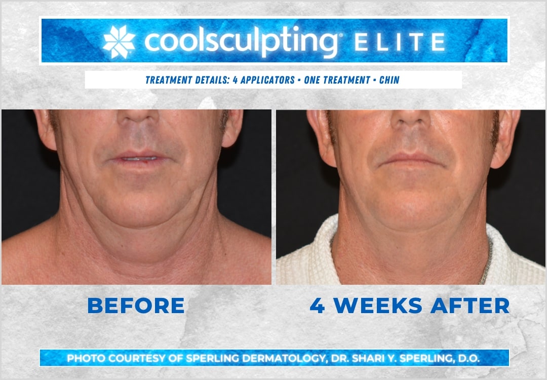 Before & After Submental Fat CoolSculpting in New Jersey
