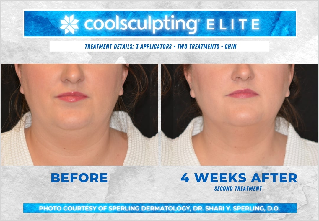 Before & After Submental Fat CoolSculpting in New Jersey