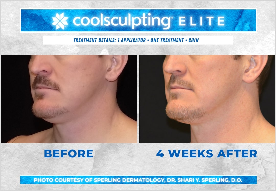 Before & After Submental Fat CoolSculpting in New Jersey