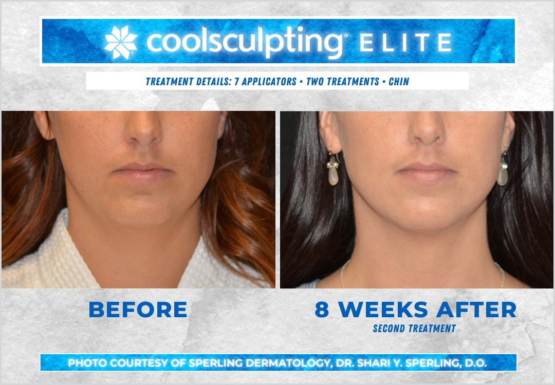 Before & After Submental Fat CoolSculpting in New Jersey