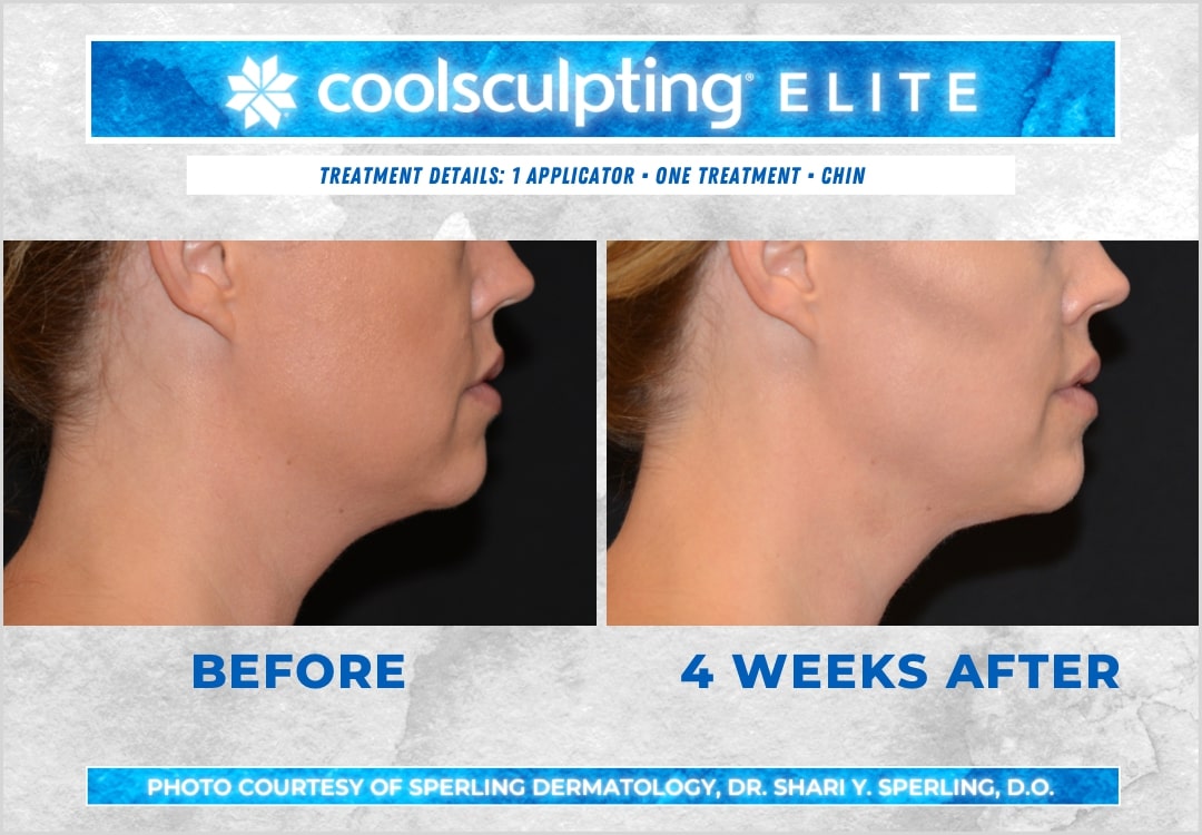 Before & After Submental Fat CoolSculpting in New Jersey