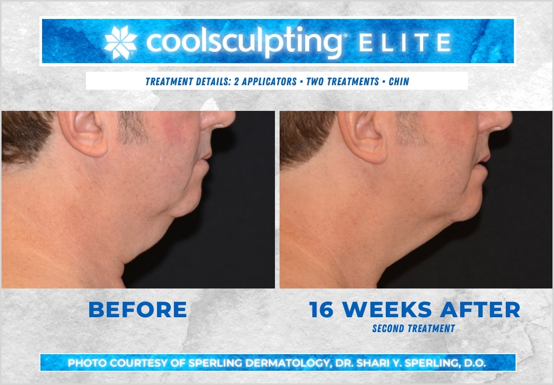 Before & After Submental Fat CoolSculpting in New Jersey