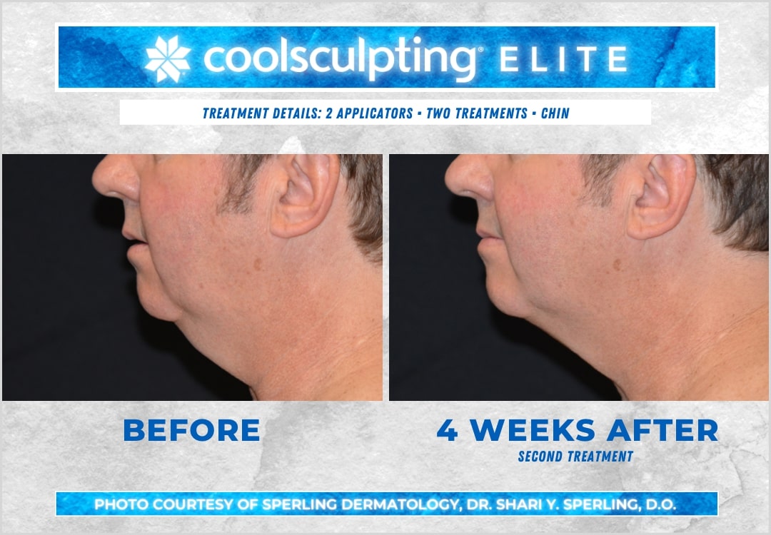 Before & After Submental Fat CoolSculpting in New Jersey