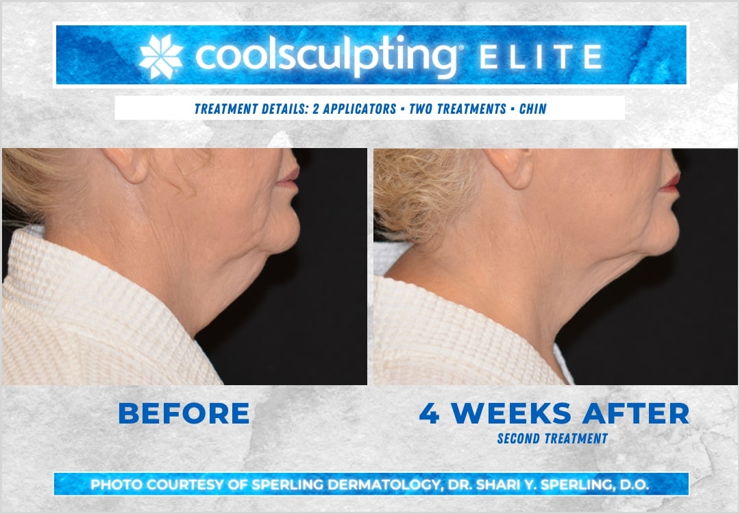 Before & After Submental Fat CoolSculpting in New Jersey