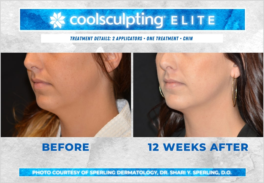 Before & After Submental Fat CoolSculpting in New Jersey