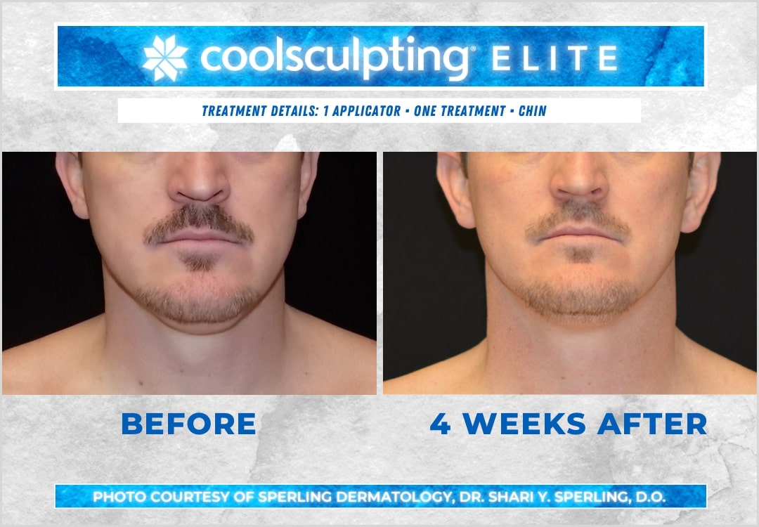 Before & After Submental Fat CoolSculpting in New Jersey