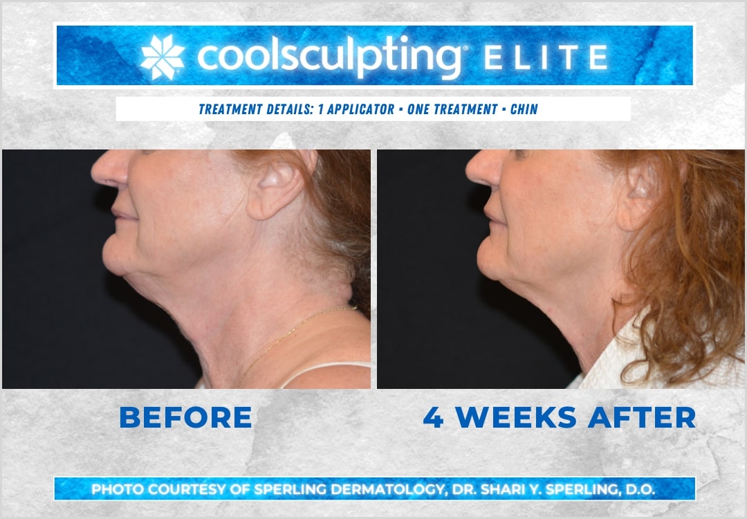 Before & After Submental Fat CoolSculpting in New Jersey