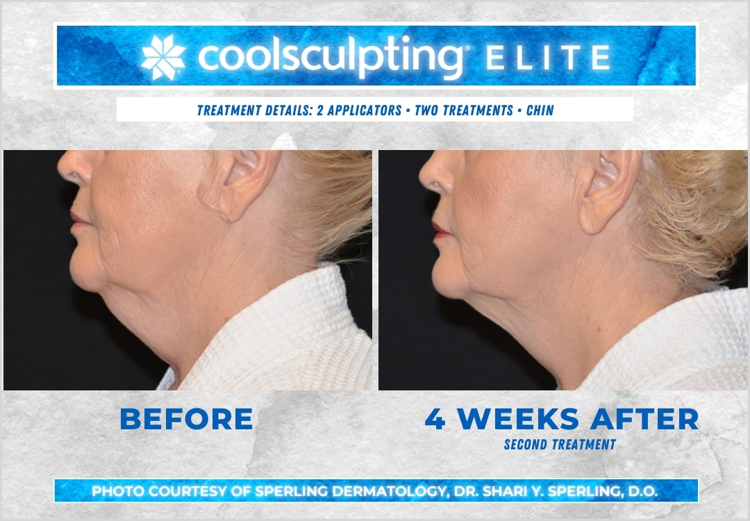 Before & After Submental Fat CoolSculpting in New Jersey