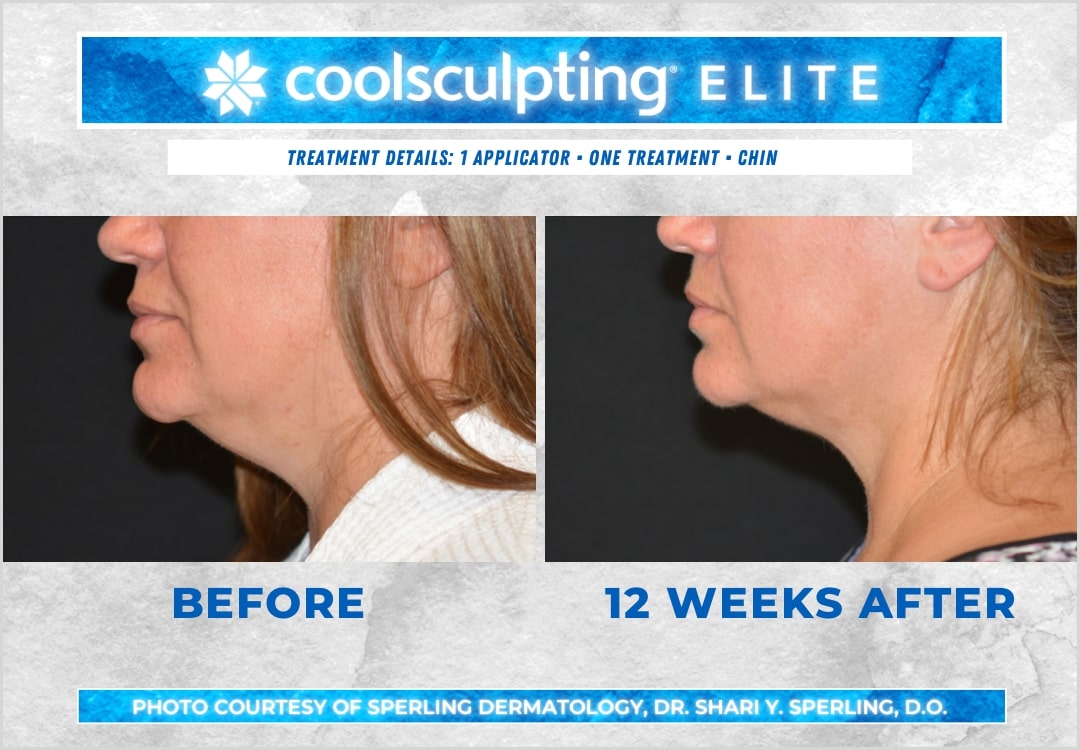 Before & After Submental Fat CoolSculpting in New Jersey