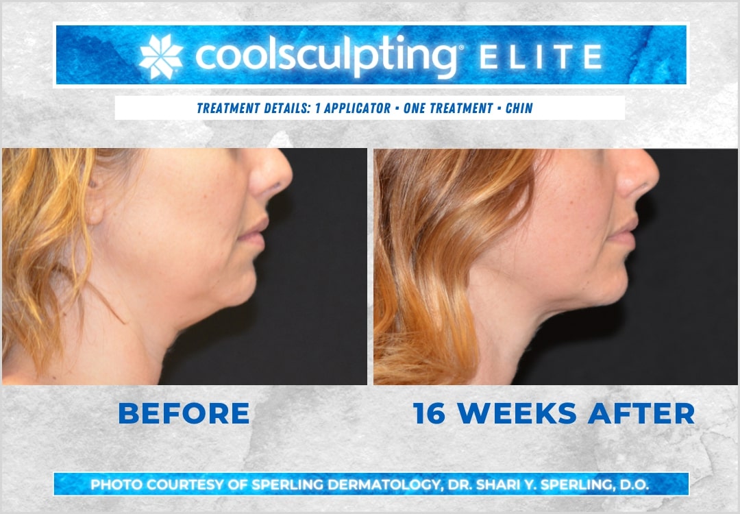 Before & After Submental Fat CoolSculpting in New Jersey