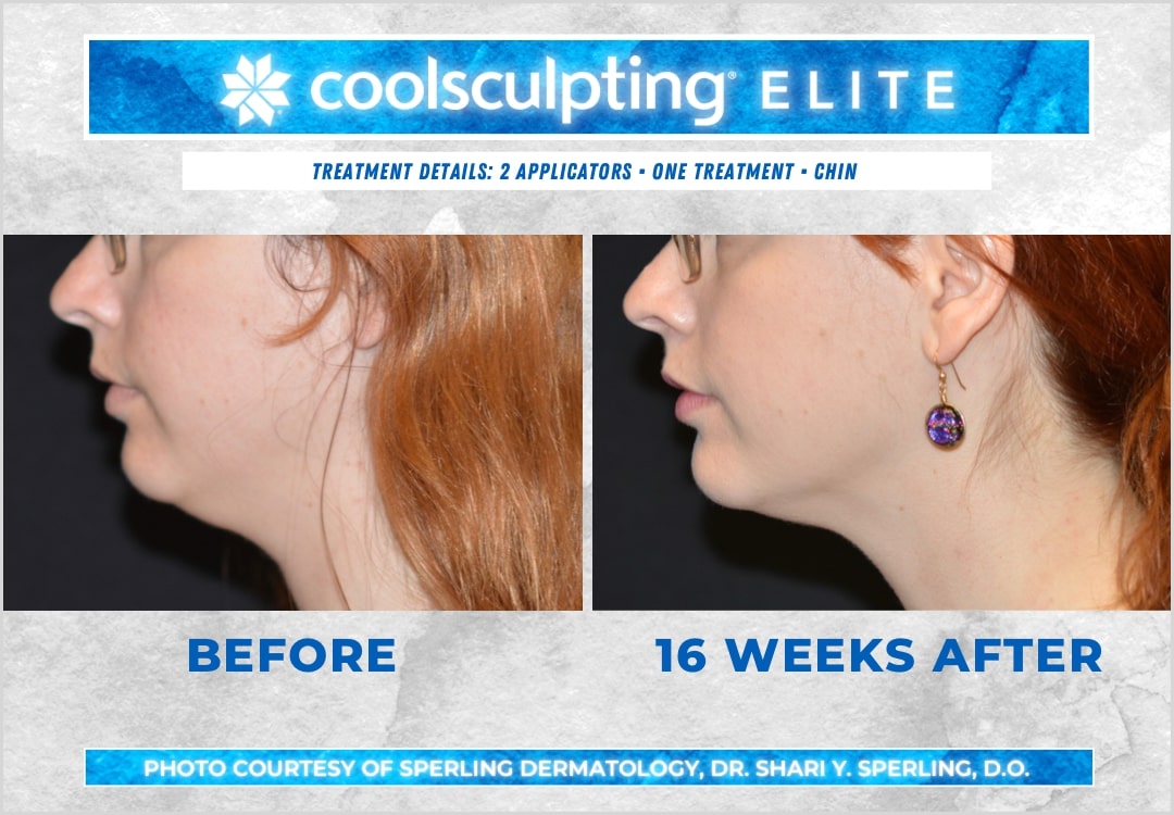 Before & After Submental Fat CoolSculpting in New Jersey