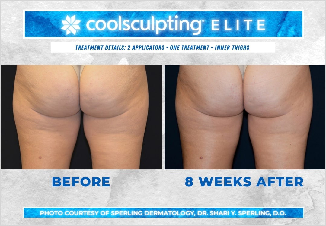 Before & After Thighs CoolSculpting in New Jersey