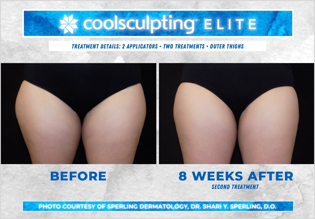 Before & After Thighs CoolSculpting in New Jersey