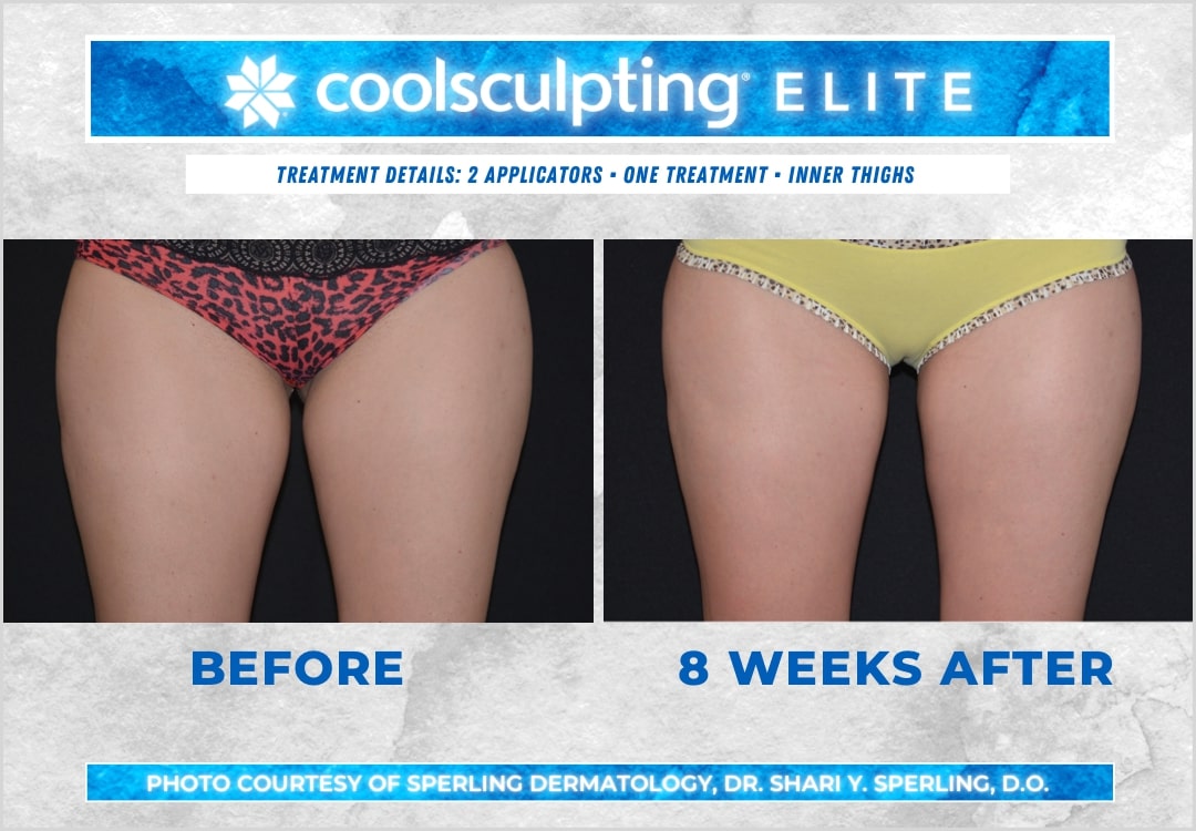 Before & After Thighs CoolSculpting in New Jersey