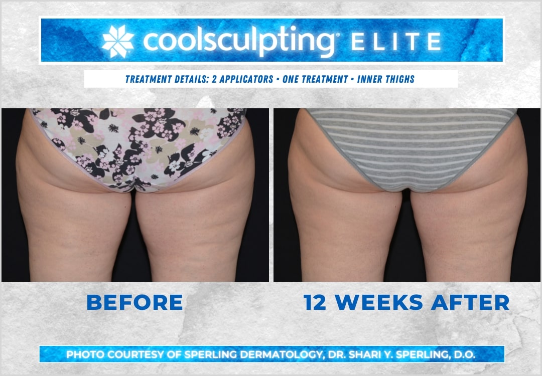 Before & After Thighs CoolSculpting in New Jersey