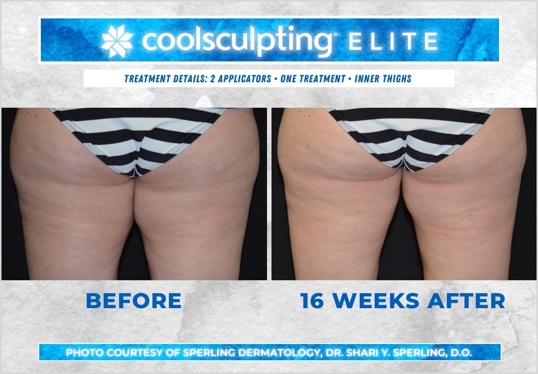 Before & After Thighs CoolSculpting in New Jersey