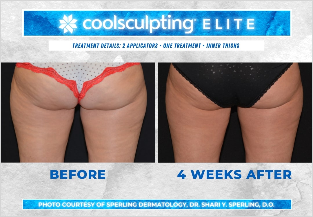 Before & After Thighs CoolSculpting in New Jersey