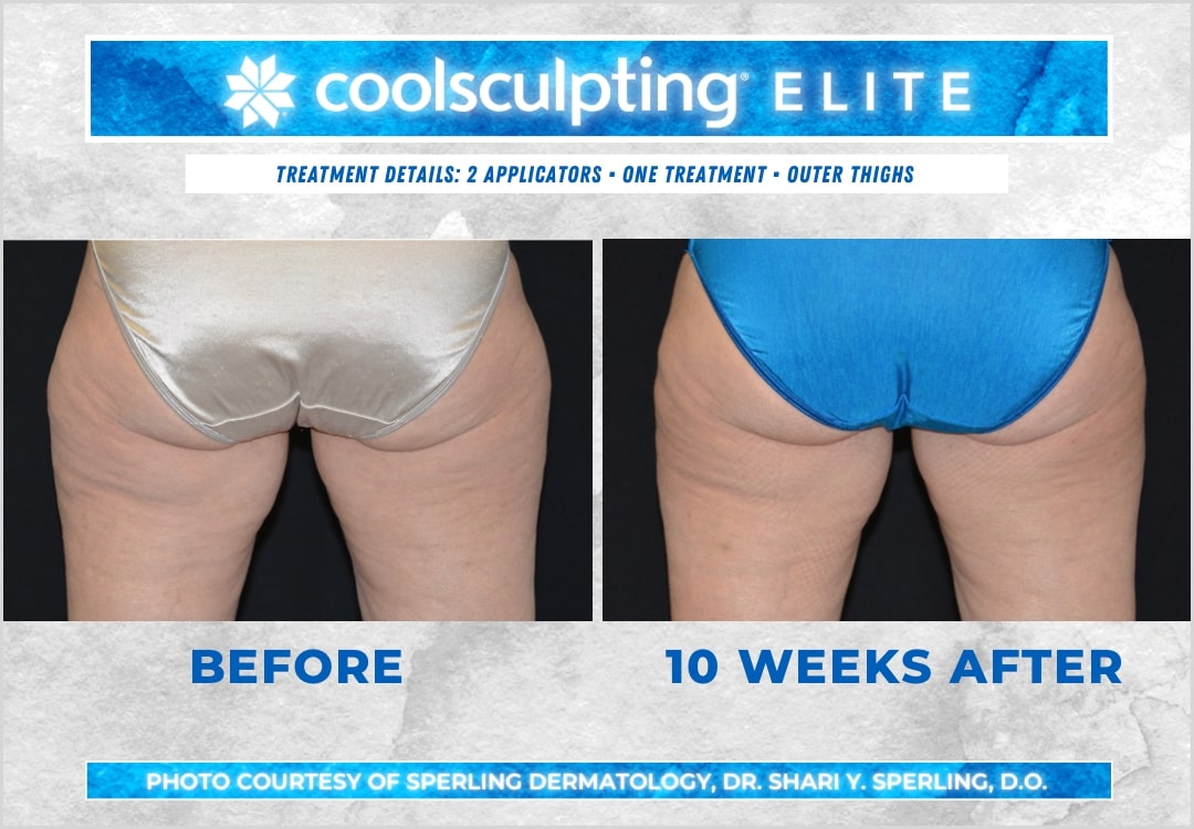 Before & After Thighs CoolSculpting in New Jersey