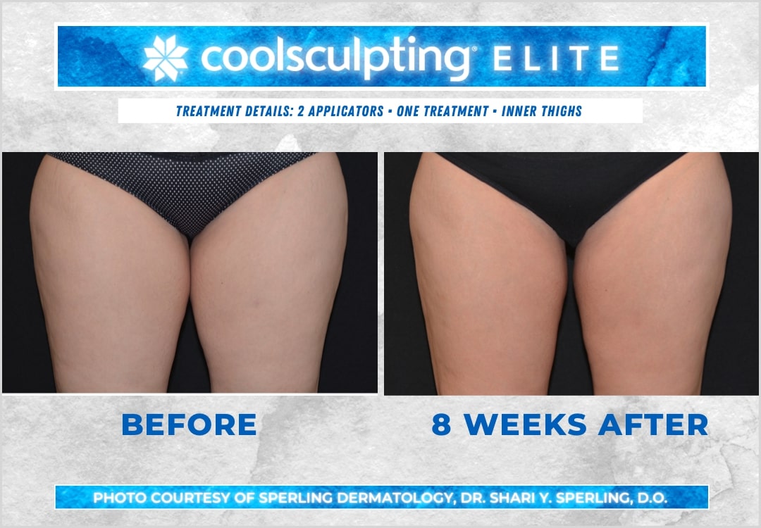 Before & After Thighs CoolSculpting in New Jersey