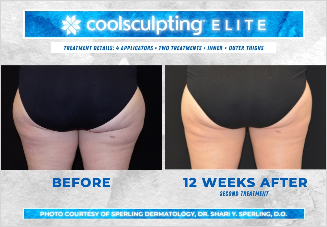 Before & After Thighs CoolSculpting in New Jersey