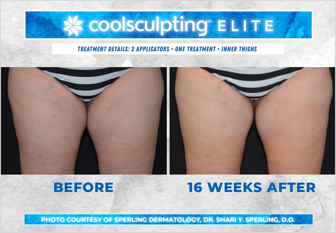 Before & After Thighs CoolSculpting in New Jersey