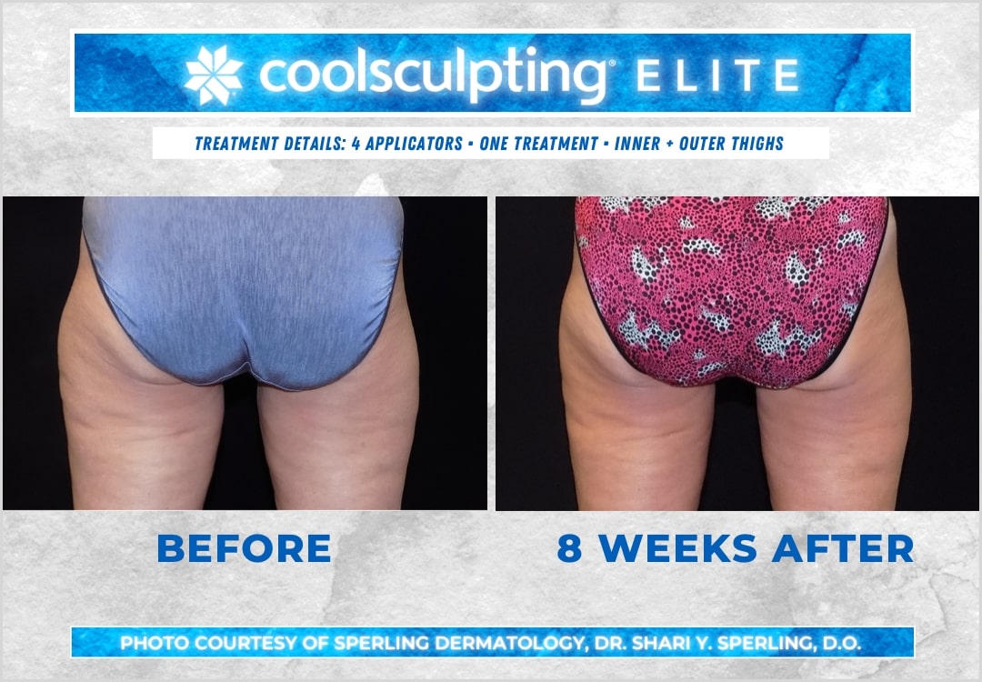 Before & After Thighs CoolSculpting in New Jersey