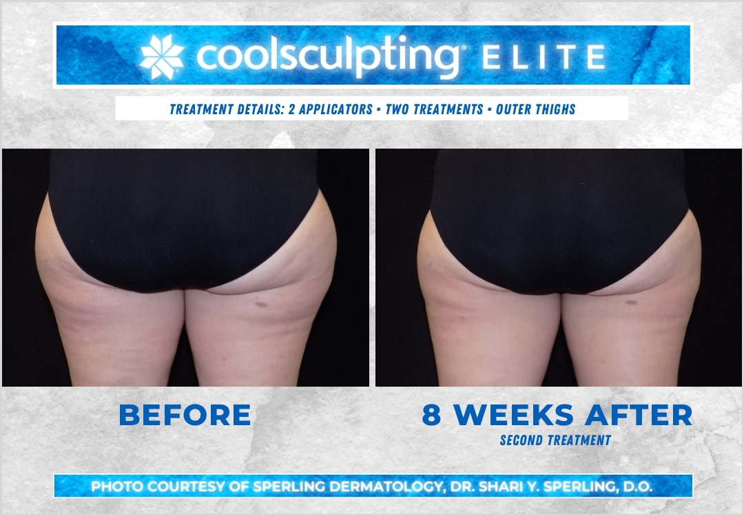 Before & After Thighs CoolSculpting in New Jersey