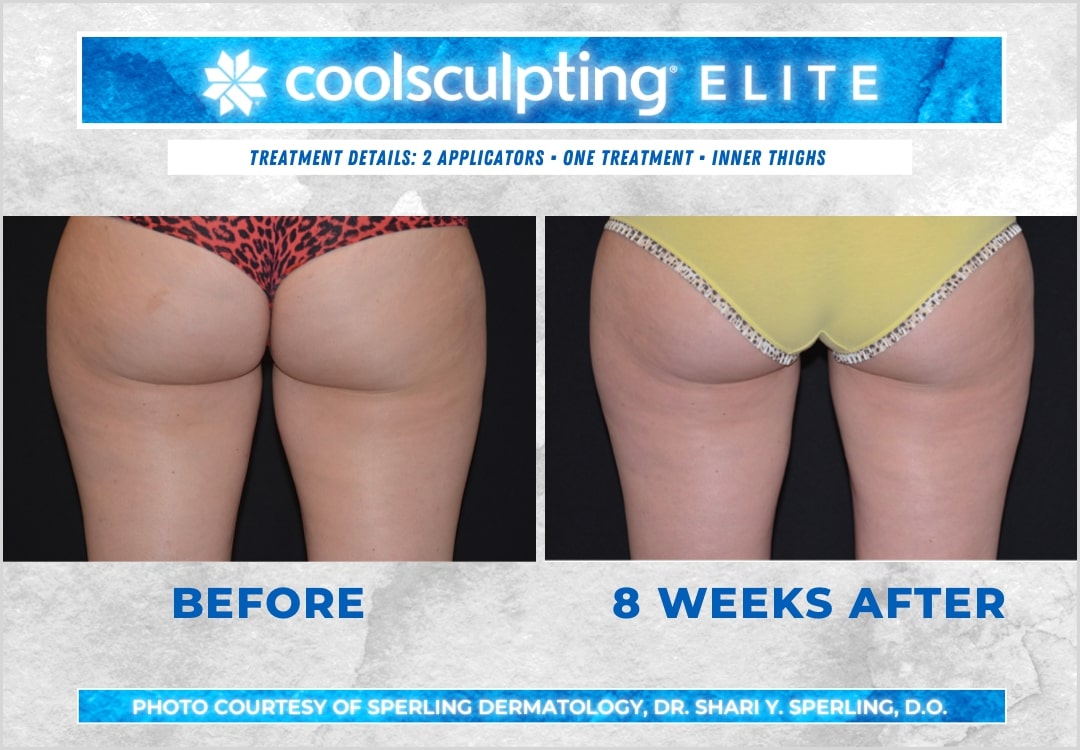 Before & After Thighs CoolSculpting in New Jersey