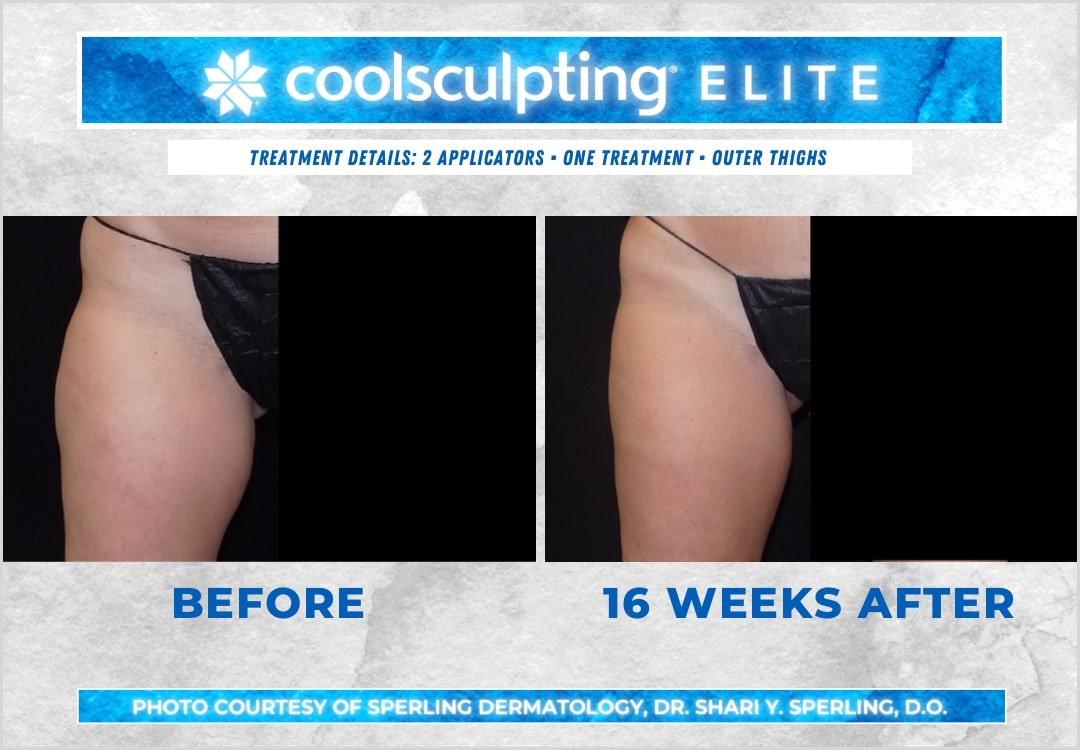 Before & After Thighs CoolSculpting in New Jersey