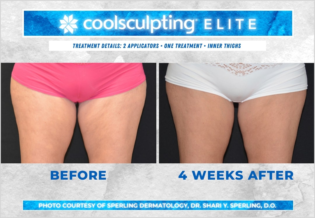 Before & After Thighs CoolSculpting in New Jersey