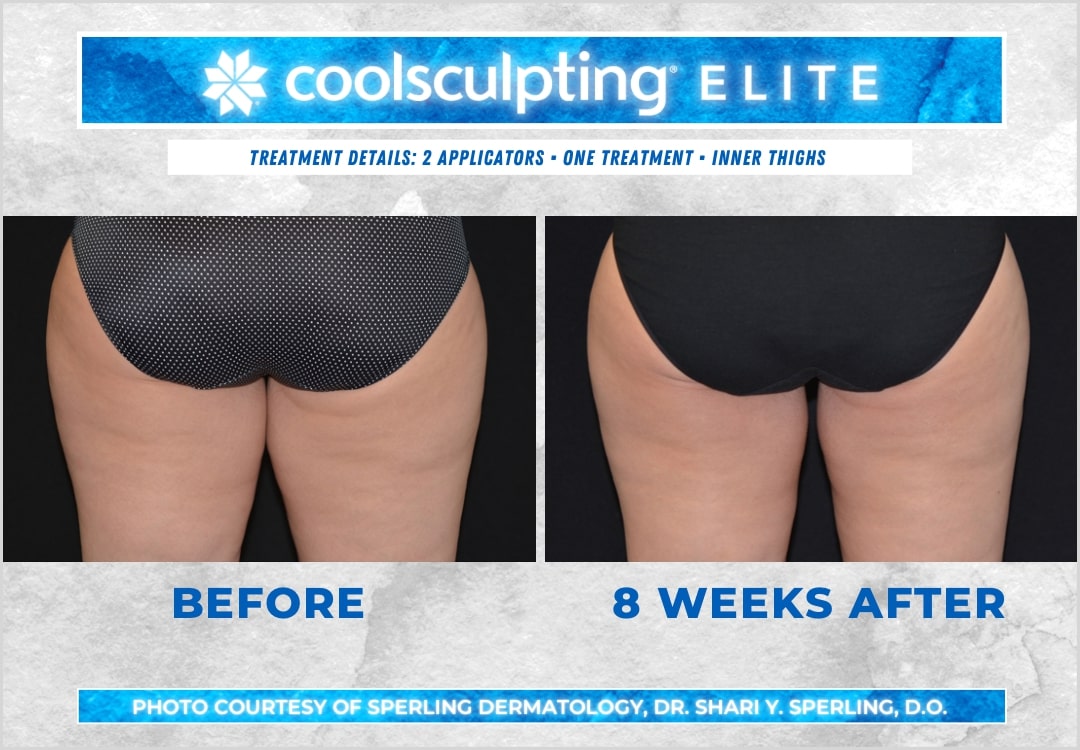 Before & After Thighs CoolSculpting in New Jersey